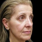 Facelift Before & After Patient #1702