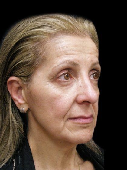Facelift Before & After Patient #1702