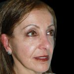 Facelift Before & After Patient #1702