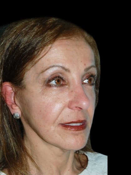 Facelift Before & After Patient #1702