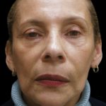 Facelift Before & After Patient #1719