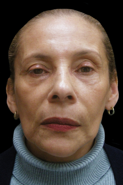 Facelift Before & After Patient #1719
