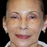 Facelift Before & After Patient #1719