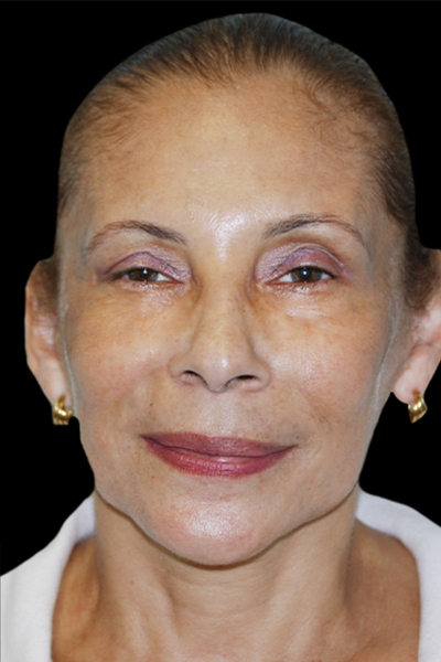 Facelift Before & After Patient #1719