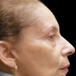 Facelift Before & After Patient #1719