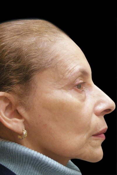 Facelift Before & After Patient #1719