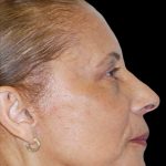 Facelift Before & After Patient #1719