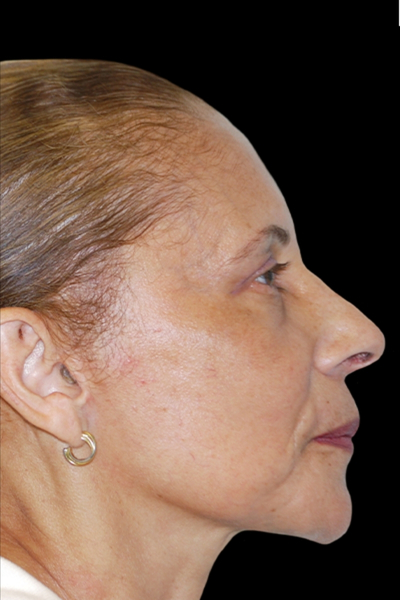 Facelift Before & After Patient #1719