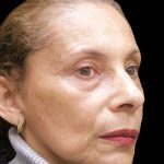 Facelift Before & After Patient #1719