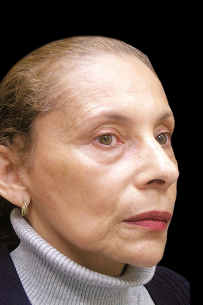 Facelift Before & After Patient #1719