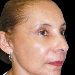 Facelift Before & After Patient #1719