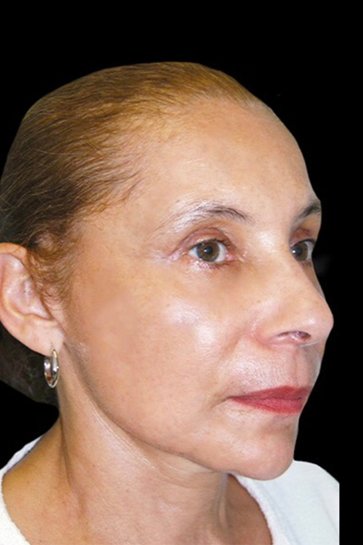 Facelift Before & After Patient #1719