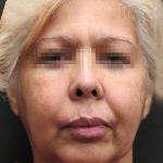 Facelift Before & After Patient #1726