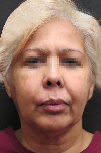 Facelift Before & After Patient #1726