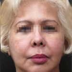 Facelift Before & After Patient #1726