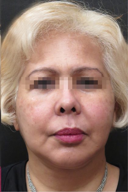 Facelift Before & After Patient #1726