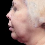 Facelift Before & After Patient #1726