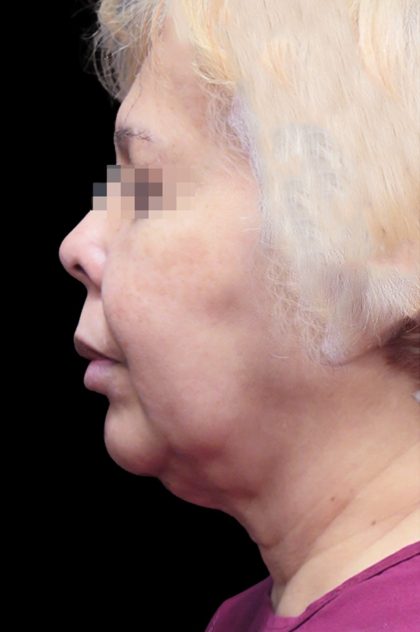 Facelift Before & After Patient #1726