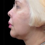 Facelift Before & After Patient #1726