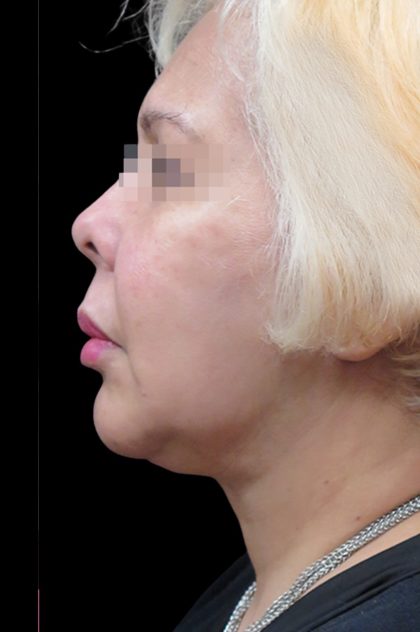 Facelift Before & After Patient #1726