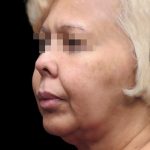 Facelift Before & After Patient #1726