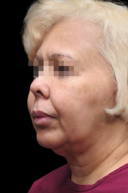 Facelift Before & After Patient #1726