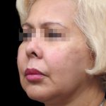 Facelift Before & After Patient #1726