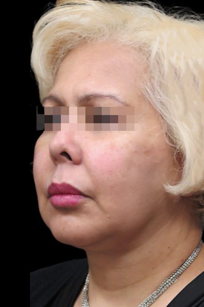 Facelift Before & After Patient #1726