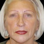 Facelift Before & After Patient #1733