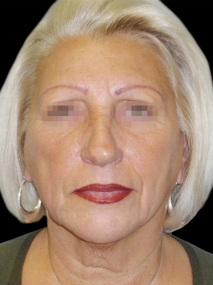 Facelift Before & After Patient #1733