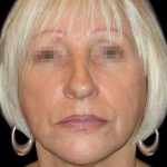 Facelift Before & After Patient #1733