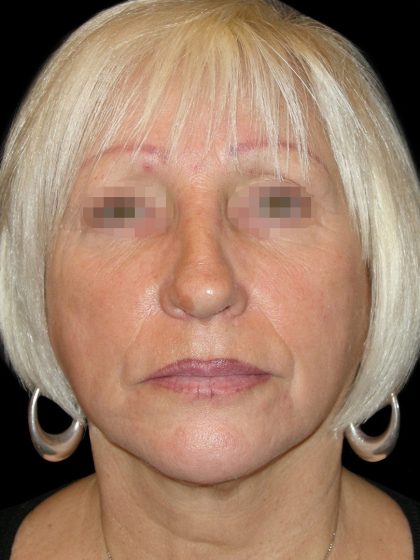 Facelift Before & After Patient #1733
