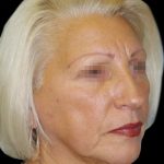Facelift Before & After Patient #1733