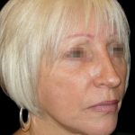 Facelift Before & After Patient #1733