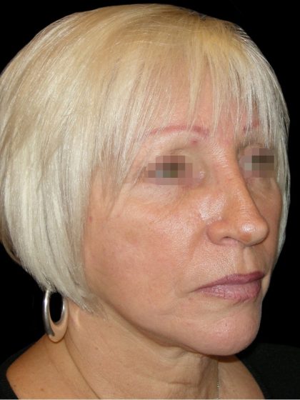 Facelift Before & After Patient #1733