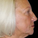 Facelift Before & After Patient #1733