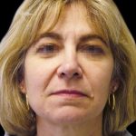 Facelift Before & After Patient #1747