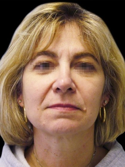 Facelift Before & After Patient #1747