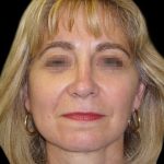 Facelift Before & After Patient #1747