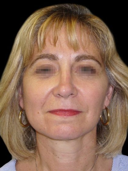 Facelift Before & After Patient #1747
