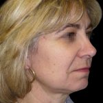 Facelift Before & After Patient #1747