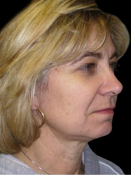 Facelift Before & After Patient #1747
