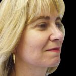 Facelift Before & After Patient #1747