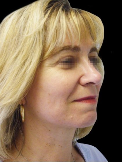 Facelift Before & After Patient #1747