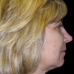 Facelift Before & After Patient #1747