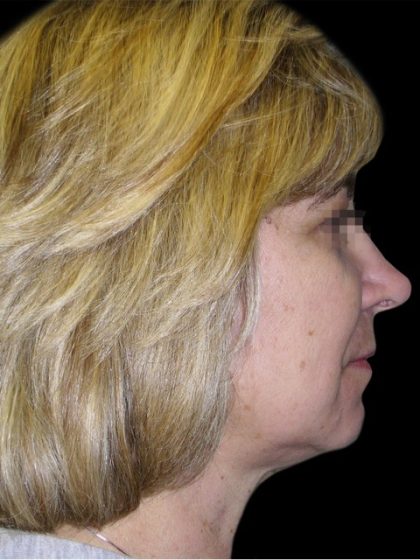 Facelift Before & After Patient #1747