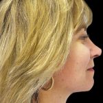 Facelift Before & After Patient #1747