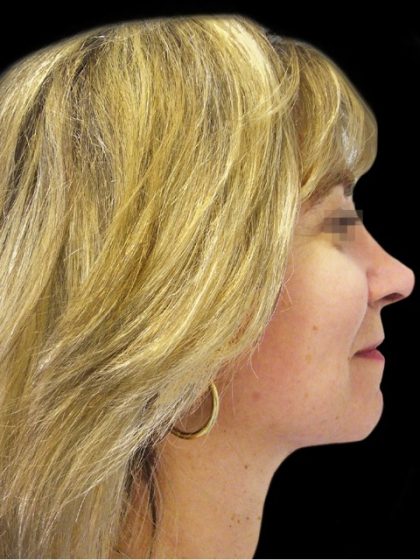 Facelift Before & After Patient #1747