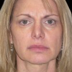 Facelift Before & After Patient #1754