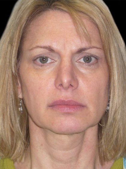 Facelift Before & After Patient #1754